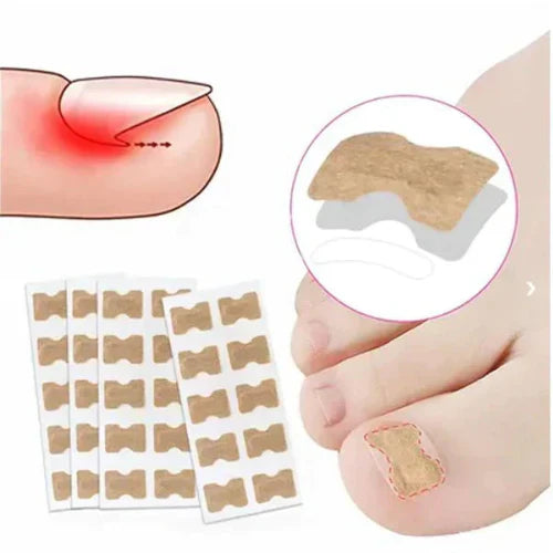 Ingrown Toenails and Fungal Infections