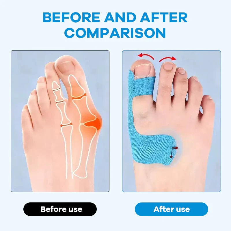 Pre-cut  Big Toe Corrector Strips