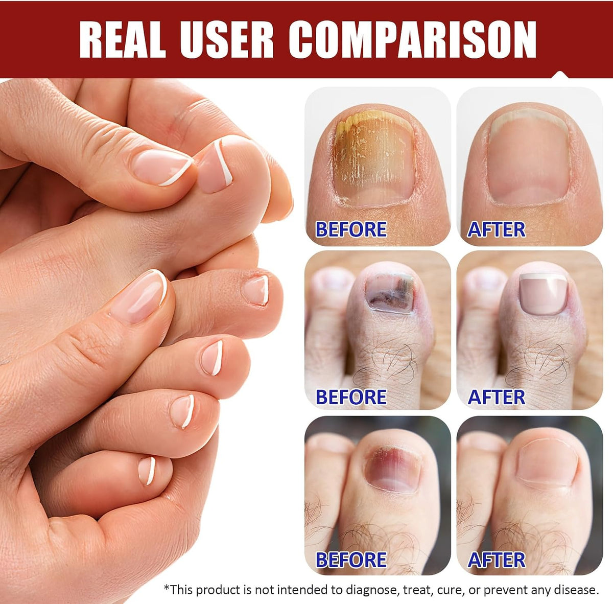 Fungal Nail Patches